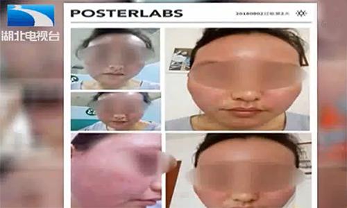 女子贴面膜毁容,女子敷面膜脸部红肿