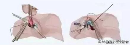 鼻翼缩小和鼻翼缩小之后的对比,超有效的缩小鼻翼的方法