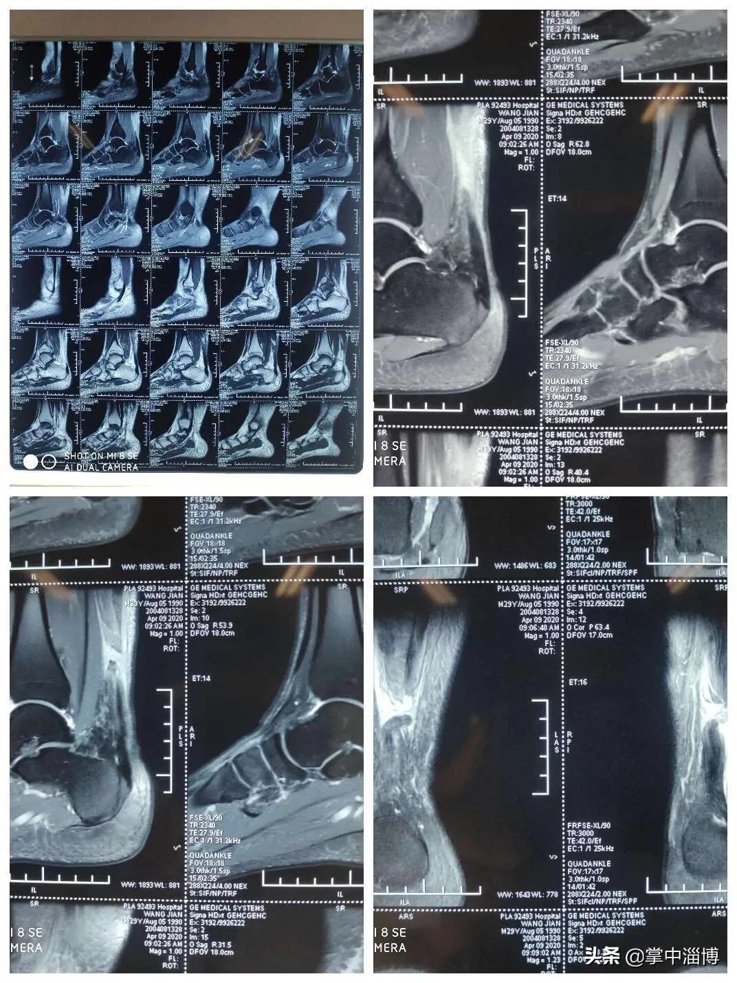 青医附院跟腱断裂微创,北医三院跟腱断裂手术修复演示