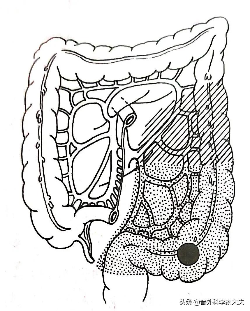 乙状结肠癌术后复发的症状是哪些,术后乙状结肠癌的护理病情汇报
