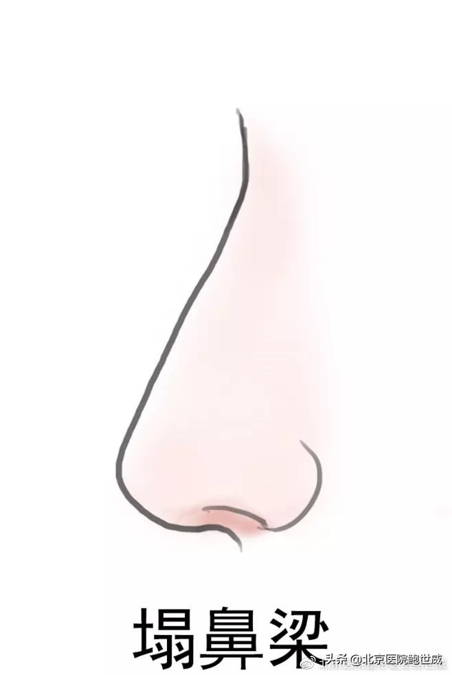 天生鼻型不完美怎么办呢,八种鼻型不佳图片