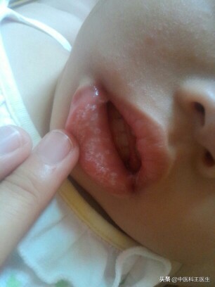 婴儿鹅口疮反复复发怎么办,氟康唑注射液治疗鹅口疮会复发吗