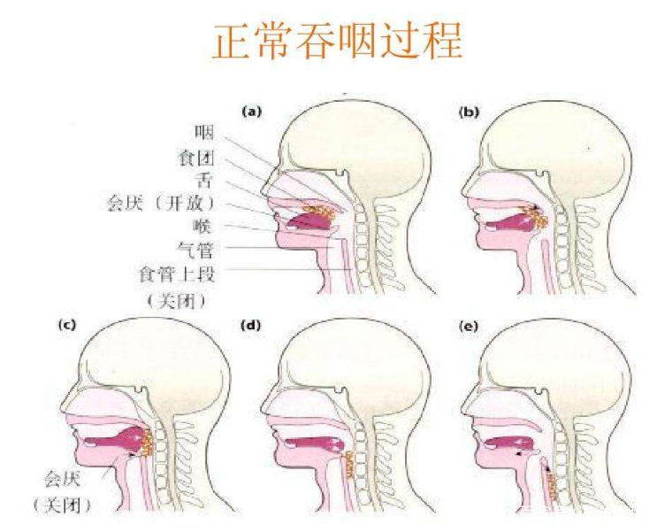 每天吞口水的次数是多少次,口水无法自行吞咽越积越多