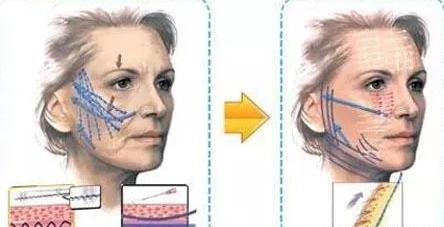 线雕是面部提升最好的方法吗,面部提升最好的方法是线雕吗