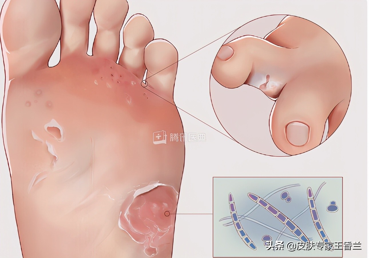 天气变暖身上就起癣是怎么回事,体癣天气越冷越严重