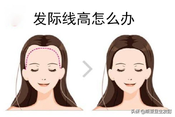 男大脑门发际线高适合什么发型,大脑门怎么降低发际线