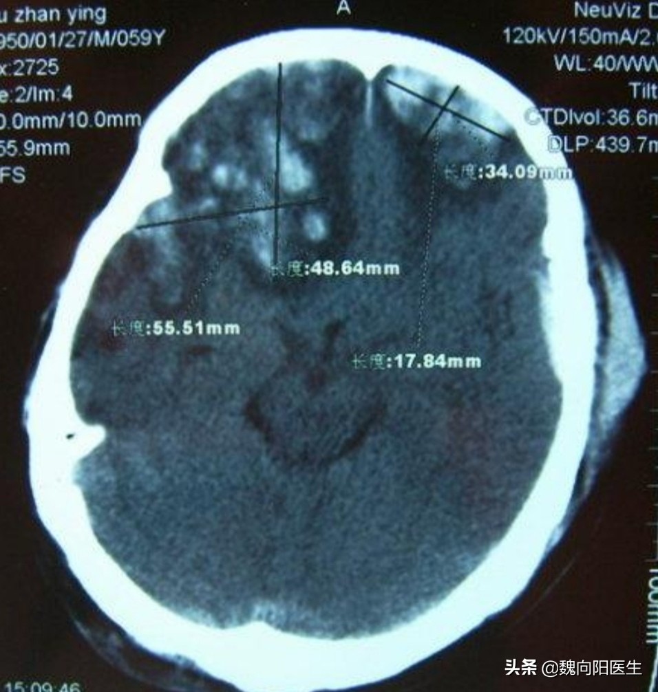 后脑勺着地有什么后果,后脑勺着地死亡率高吗