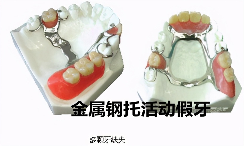 牙科医生讲义第七讲：可摘局部义齿初戴