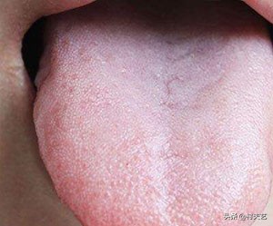 舌苔与疾病对照表详细,舌苔黑是什么疾病产生