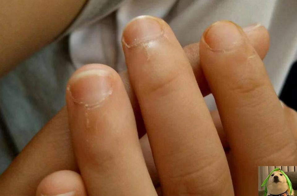 孩子手上老是有倒刺是缺乏什么,手指起皮长倒刺是缺乏什么维生素