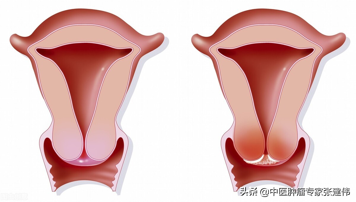 发现宫颈癌前病变，会变成宫颈癌吗？出现这几个“信号”要警惕