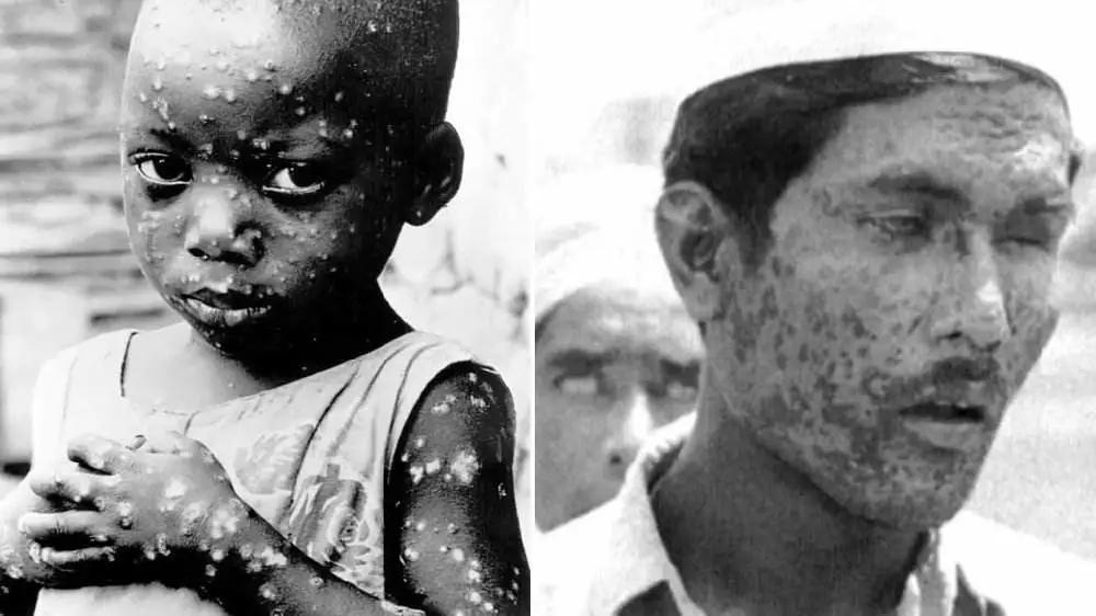 天花病毒如何干掉人类,天花病毒怎么意外消灭的