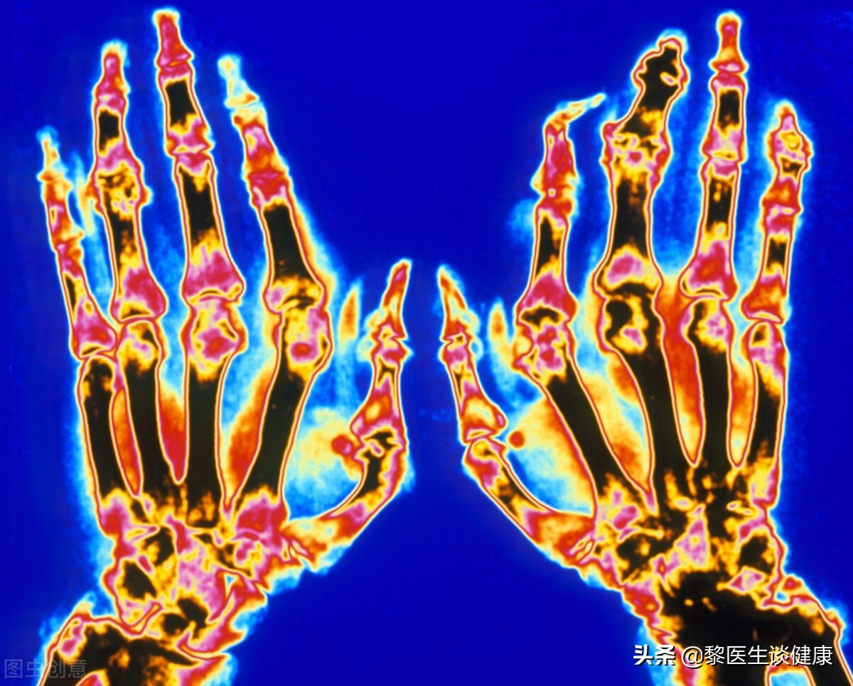 痛风反复发作怎么办呢,痛风反复发作吃什么药治疗最有效