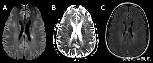 脑卒中病历诊断书图片,脑卒中影像判断技巧图解电子版