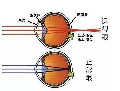 美国关于近视最新研究成果,美国儿童科学研究