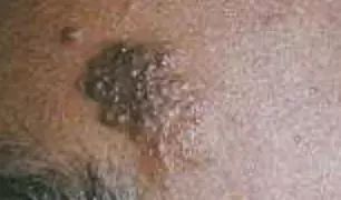 身上长小肉粒可以抠掉吗?小肉粒“偏爱”这些人