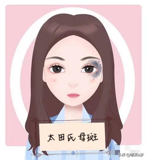 雀斑晒斑怎么去除中医,晒斑怎么祛斑最有效既省钱又简单