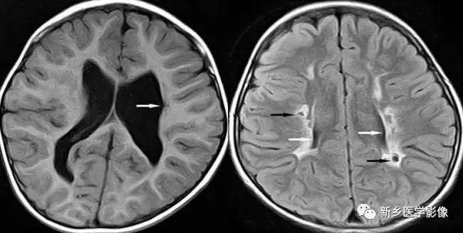 什么引起成人脑室扩大,哪些病可以导致左侧脑室增宽