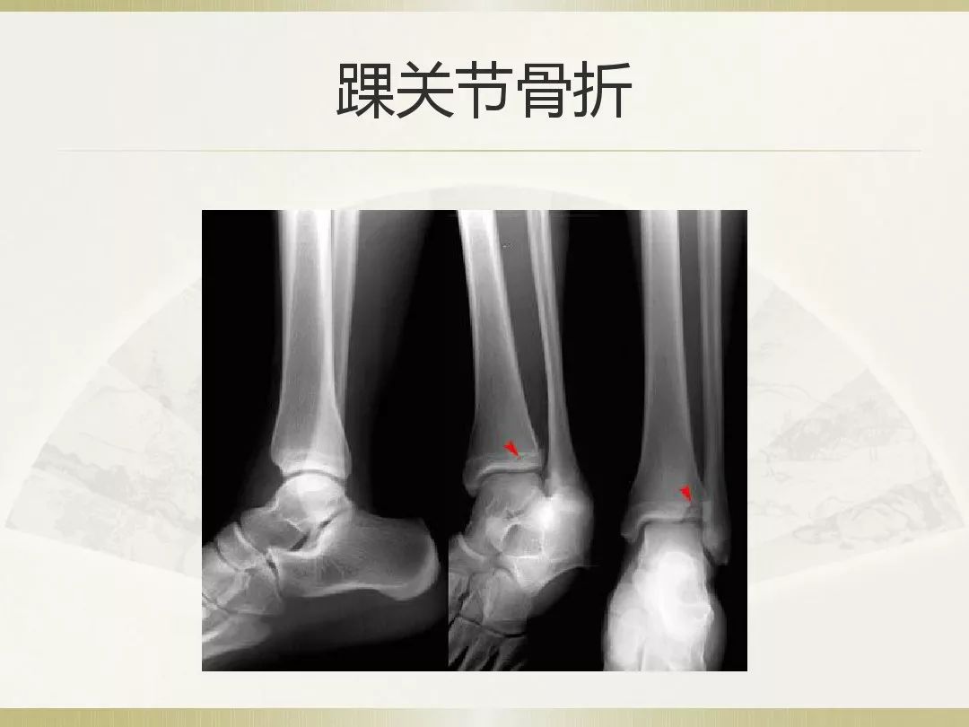 骨科x光片读片技巧,放射科骨科读片教程