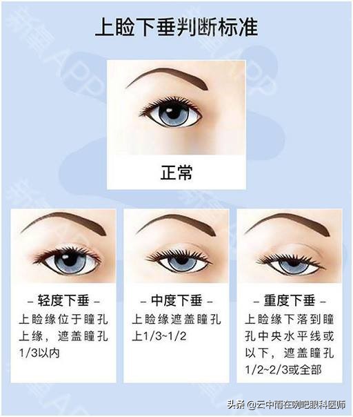 先天性眼睛上睑下垂严重怎么治疗,先天性上睑下垂恢复