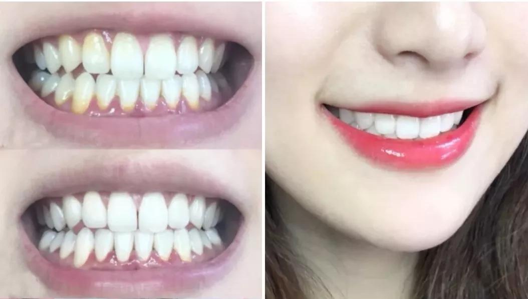 真正能把牙齿刷白的牙膏测评,进口去牙渍牙垢牙黄的牙膏第一名