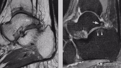 陈旧性踝关节损伤的治疗,踝关节损伤现场处理视频