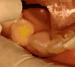 洗牙每年洗一次对牙齿好吗,多久洗一次牙为好洗牙多少钱