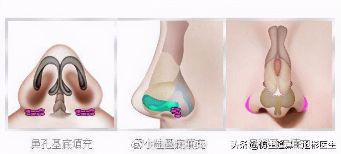 隆鼻鼻型科普,鼻基底凹陷隆鼻可以改善吗