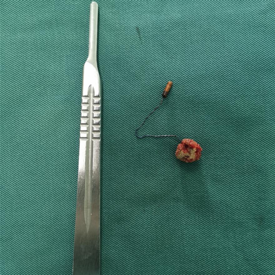 现实版“越狱”咸阳市第一人民医院大咖联手擒拿“逃犯”