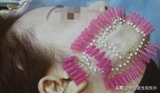 脸上做完埋线多久起效果,做完埋线为什么脸上有坑