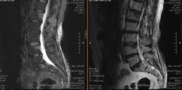 癌症骨转移是骨头疼还是肌肉疼,癌症骨转移骨头会凸起吗