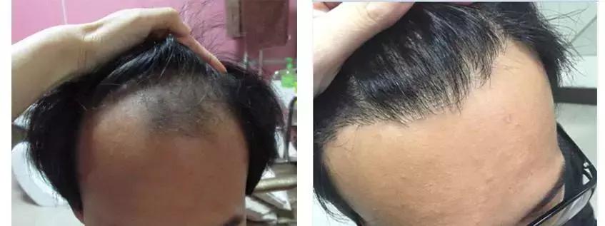 两侧头发后移怎么办,天生额角两侧没有头发怎么办