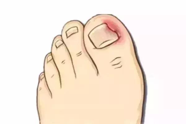 如何取出脚趾甲长进肉里,脚趾甲长进肉里需要拔甲吗