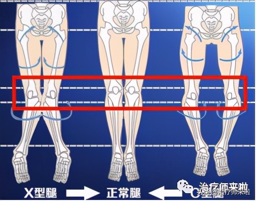 怎样可以使腿型更直,如何使腿型更好