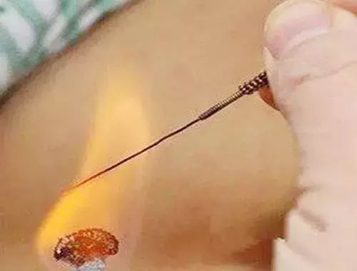 腰缠万贯到底是什么,腰缠万贯是什么病