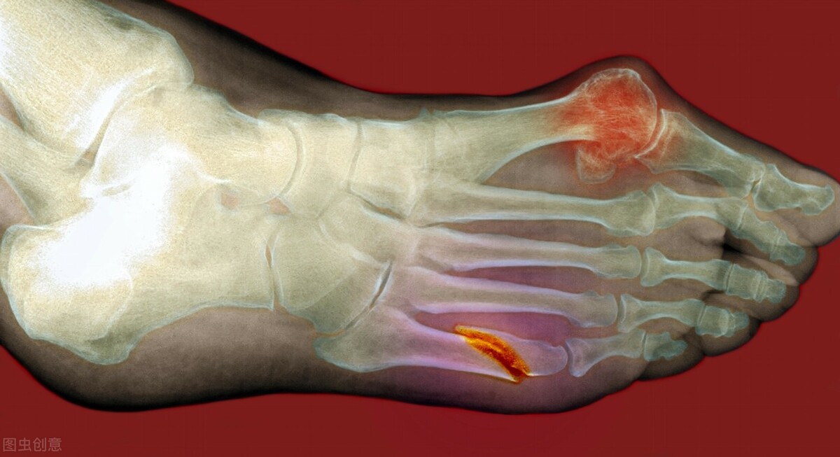 痛风不治而愈,中医治疗痛风消肿止痛最快方法