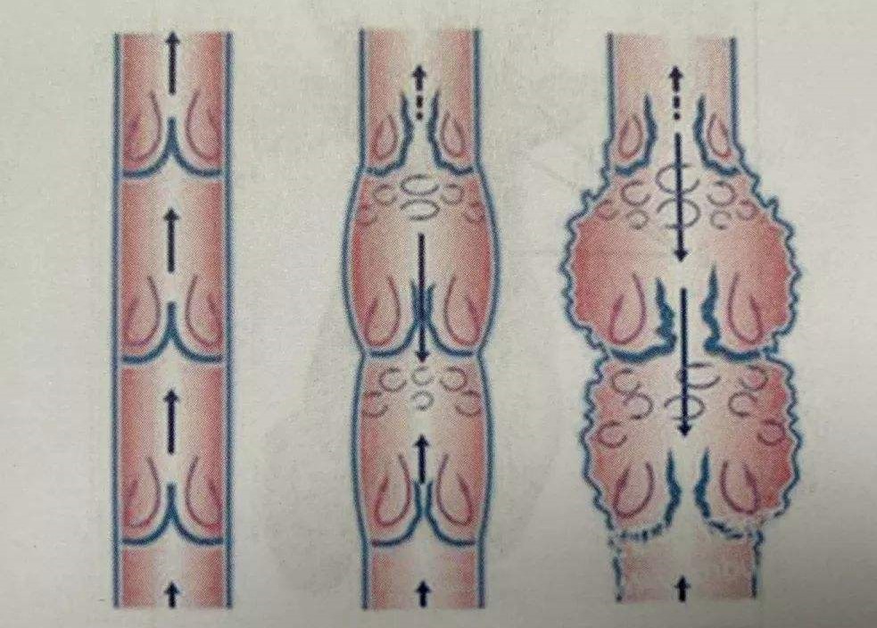 儿童精索静脉曲张会影响以后生育吗？怎么治疗？