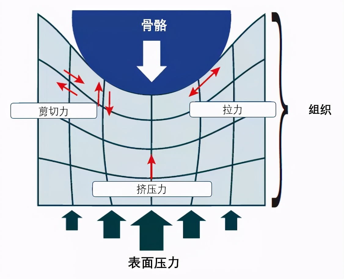 世界压疮预防日活动的起源,世界压疮日活动方案2023