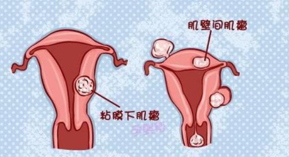 子宫肌瘤引起的贫血应该怎么根治,子宫肌瘤引起的贫血如何调养