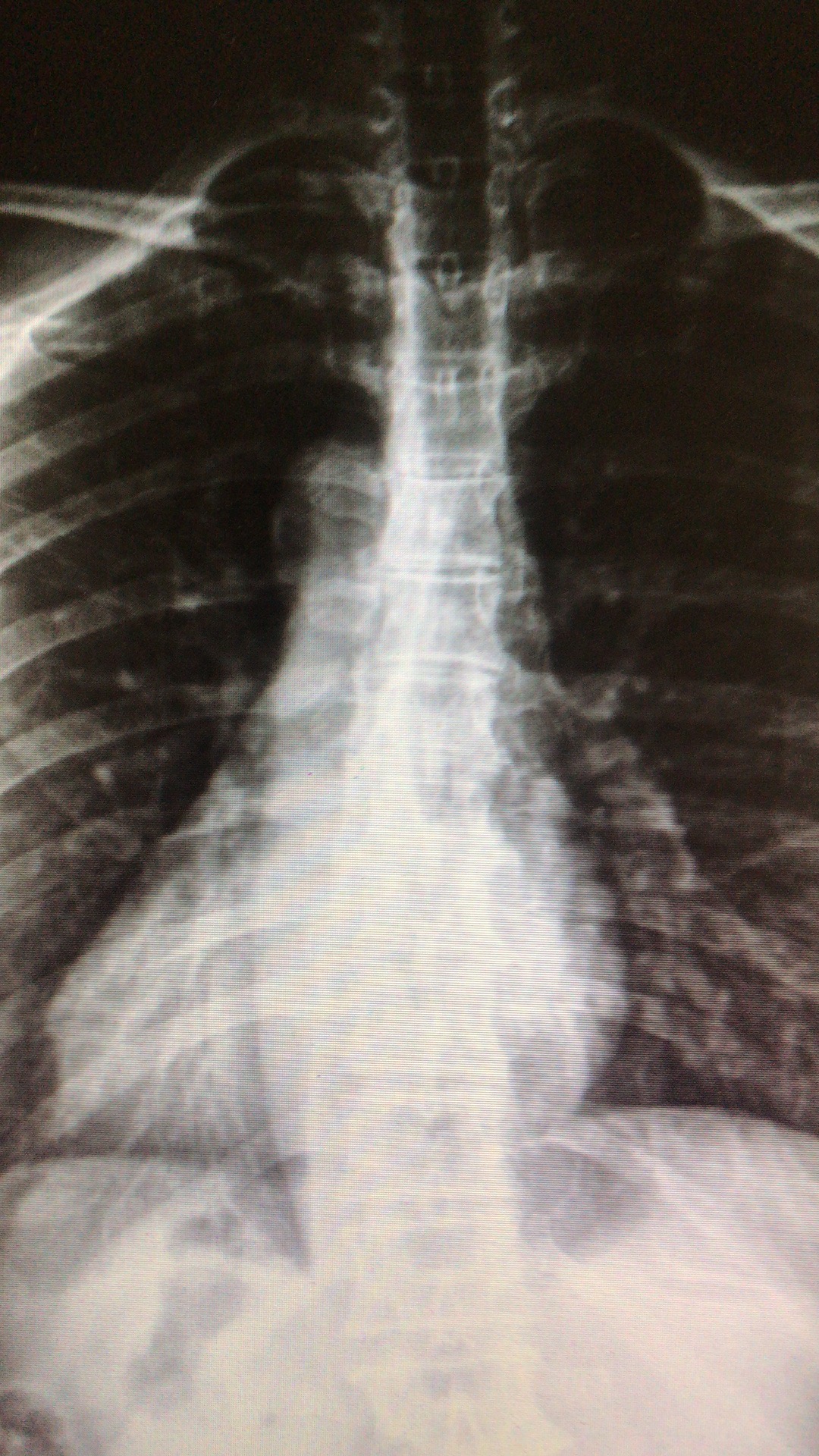 歪着身子睡觉引起脊柱侧弯,脊柱侧弯男