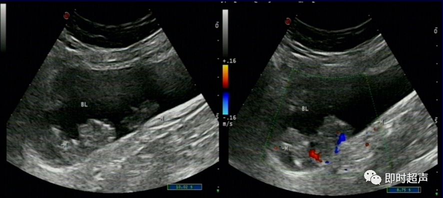 膀胱超声图解大全,膀胱超声解剖及常见病变超声表现
