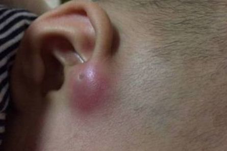 孩子耳朵边长了个疙瘩怎么切除,小朋友耳朵有畸形多大可以动手术