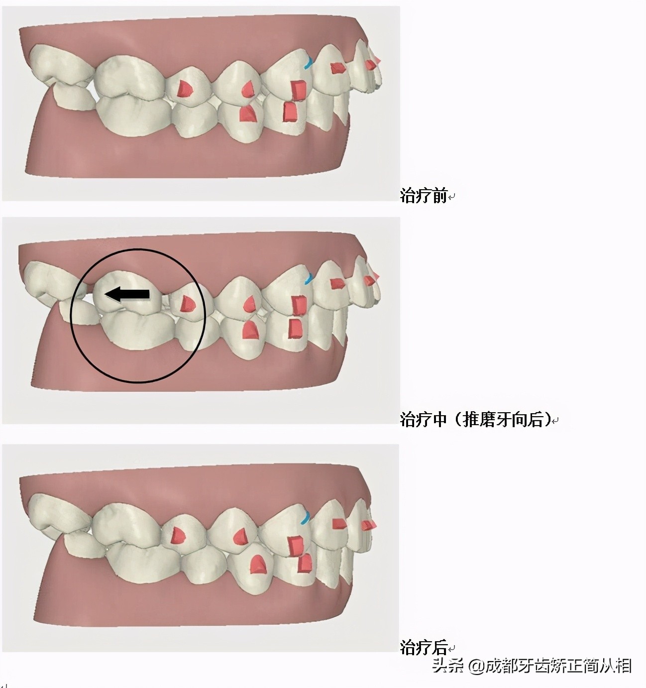 儿童牙齿拥挤矫正,牙齿拥挤矫正过程