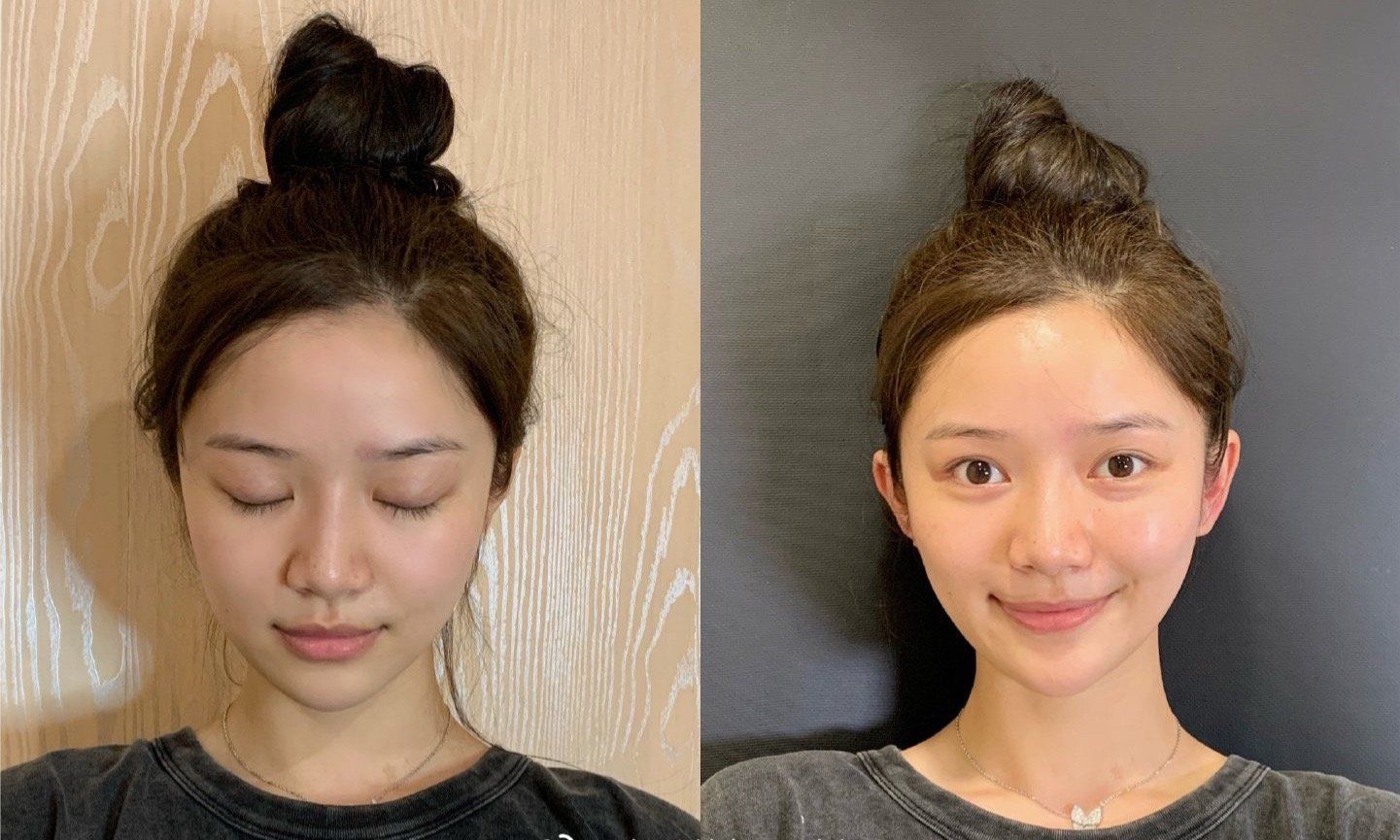 20万玻尿酸,一连打6支玻尿酸会怎么样