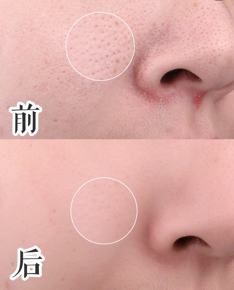 鼻子上的黑头粉刺怎么经常出来,自己挤鼻子黑头粉刺的正确方法