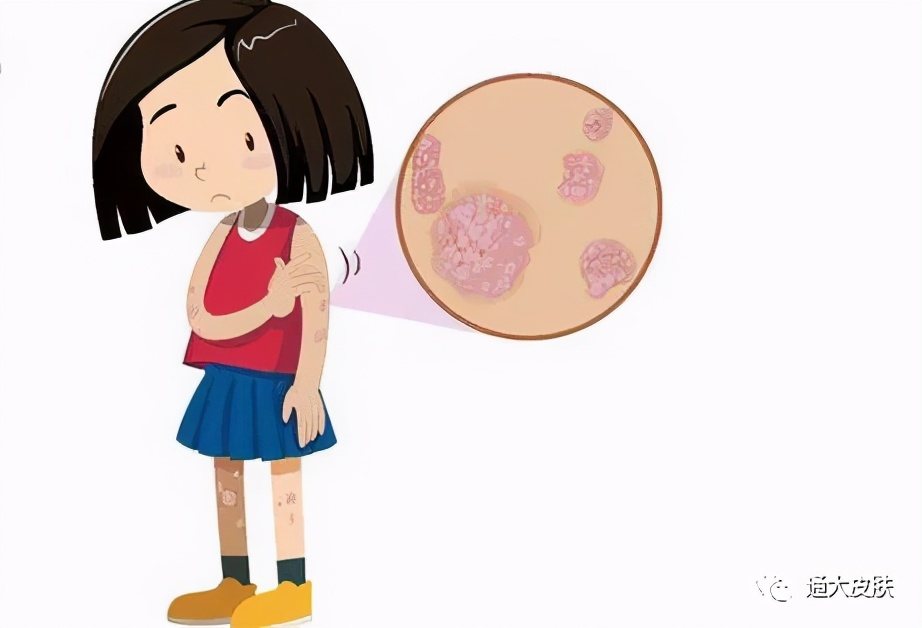 人老了身上为什么会长疮,人老了长疣什么原因