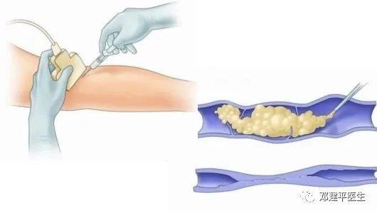 毛细血管扩张红血丝需要治吗,下肢毛细血管扩张硬化