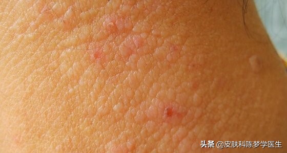 突然得了牛皮癣,牛皮癣在古代是什么病