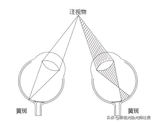 两只眼睛只有一只近视,一个眼睛近视了不戴眼镜会怎么样