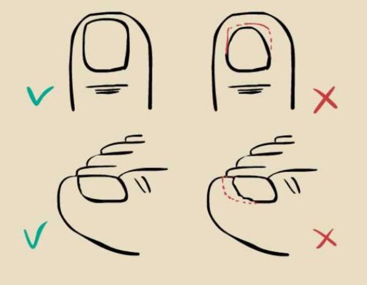 剪指甲会剪出甲沟炎吗,剪脚指甲的专用剪刀甲沟炎